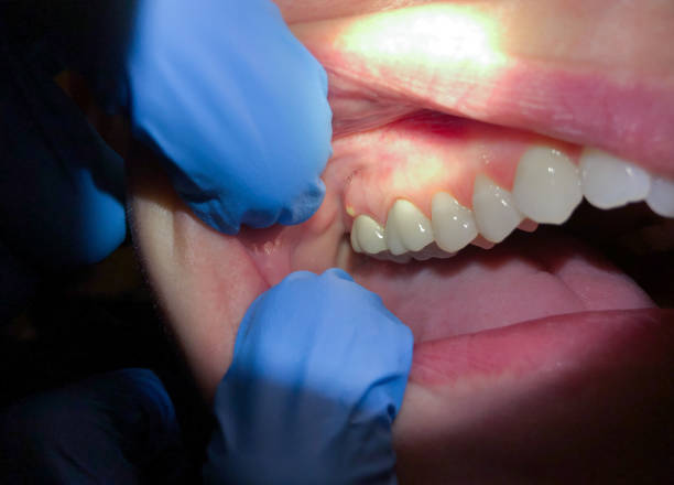 Best Emergency Wisdom Tooth Extraction in Ridgetop, TN